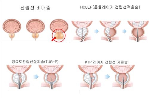전립선비대증에 '홀렙수술' 환자 만족도 높아 - 2