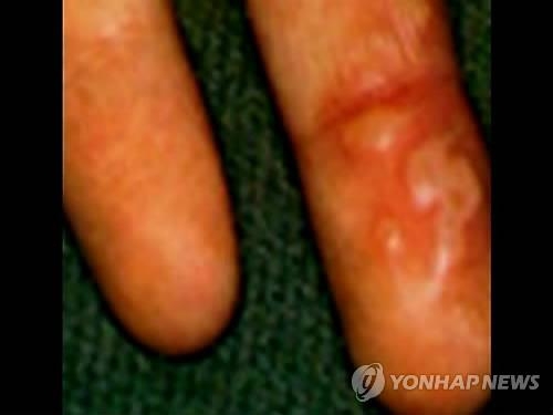 "우리 아이 손발에 물집이"…전국 수족구병 '비상' - 3