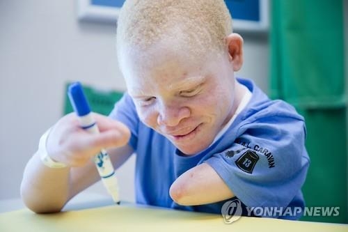 '하얀 흑인' 탄자니아 백색증 환자 "우리도 똑같은 사람" - 4