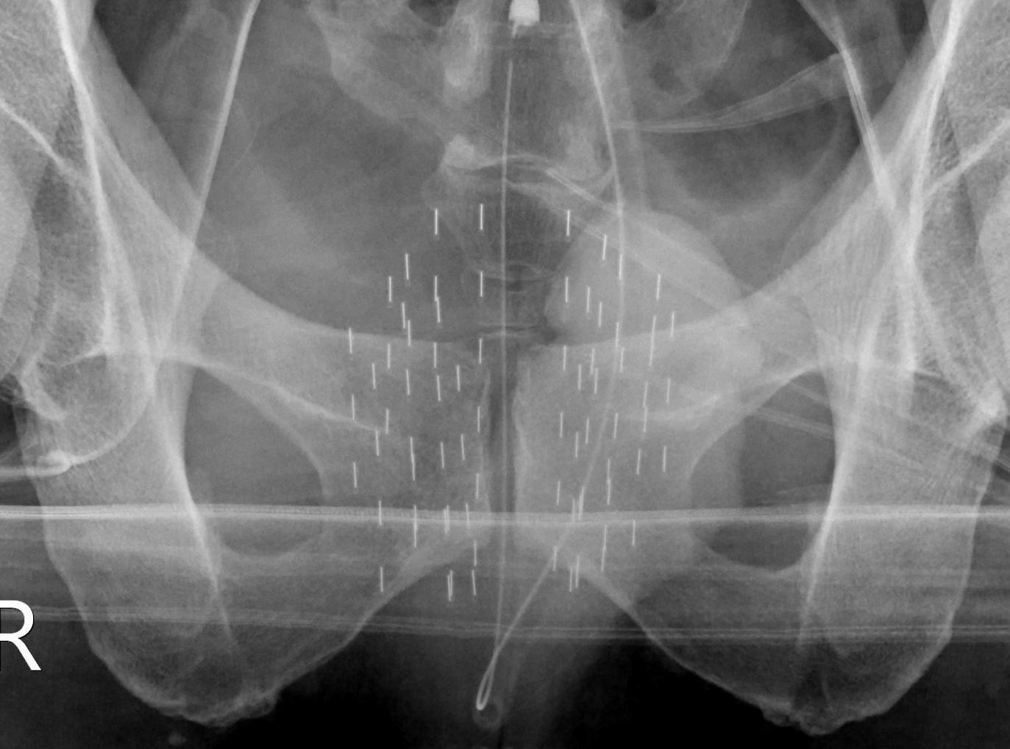 브라키 테라피 시술직후 투시 X-ray 사진. 가지런히 배열된 방사선 동위원소를 확인할 수 있다. [세브란스병원 제공=연합뉴스]