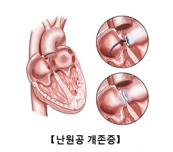 "뇌경색 부르는 '구멍난 심장'…약물보다 시술치료가 효과" - 2