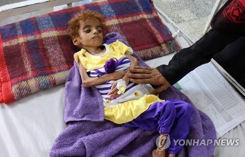 영양실조로 고통받고 있는 예멘의 어린이