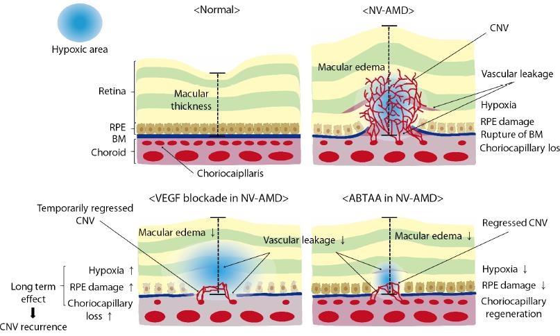 항체(ABTAA)를 이용한 신생혈관 동반 연령 관련 황반변성(NV-AMD) 치료법 설명그림