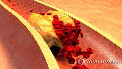콜레스테롤이 쌓인 혈관