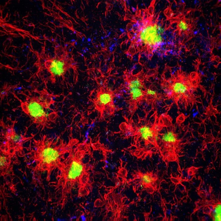 알츠하이머 환자의 뇌에서 플라크(녹색)를 공격하는 미세아교세포(붉은색)