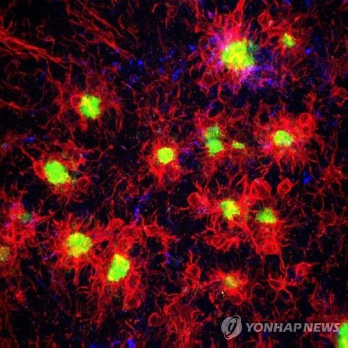 알츠하이머병 환자의 뇌에서 플라크(녹색)를 공격하는 소교세포(붉은색)