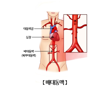 복대동맥