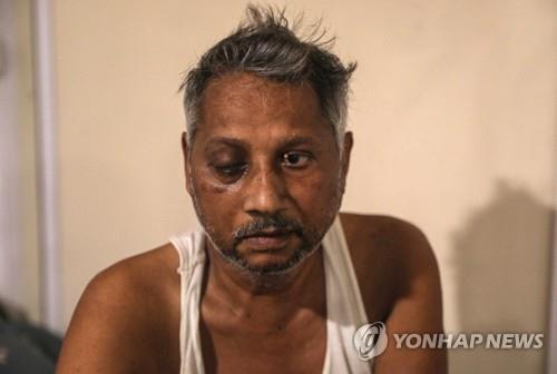 인도 '검은 곰팡이증' 3만1천명…면역 떨어진 코로나 환자 다수