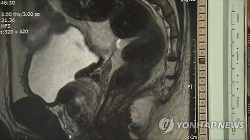 전립선 초음파 사진