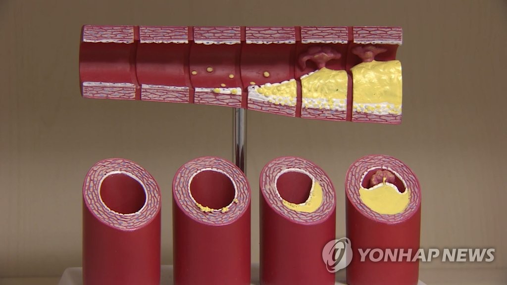 동맥경화