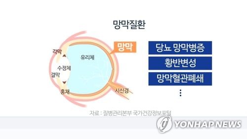 망막질환(CG)