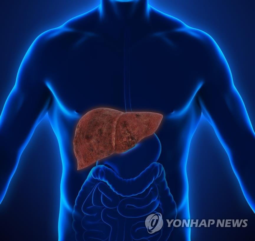 간경변