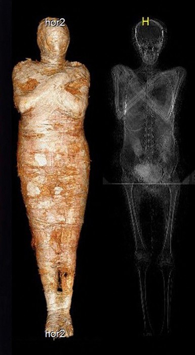 고대 이집트의 임신부 미라의 엑스레이 사진
