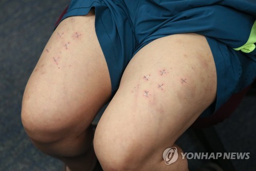 중국 괴한들이 허벅지에 21개의 스테이플을 박아넣었다고 주장하는 하워드 람