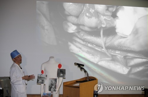 북한 귀순 병사 배에서 나온 기생충
