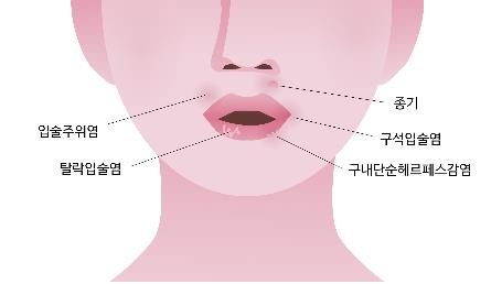 입 주변 뾰루지