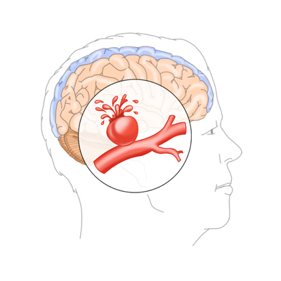 뇌동맥류