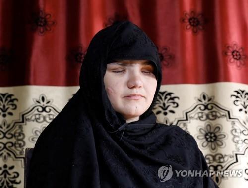 아프간 여성, 취직했단 이유만으로 '두 눈' 공격당해