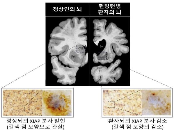 Discovery Of The Mechanism Of Neuronal Damage That Causes 'Huntington's ...