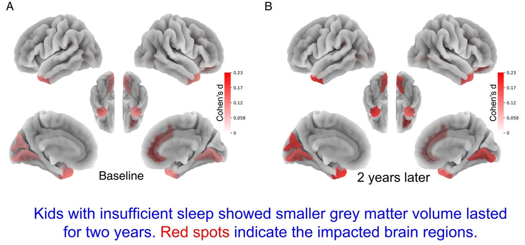 수면량에 따른 어린이 뇌 회백질 부피 변화 비교 MRI 사진