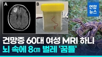 [영상] 호주서 건망증 앓던 여성 뇌 속에 8㎝ 벌레 '꿈틀'