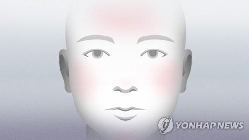 안면홍조 (PG)