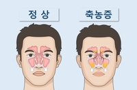 [위클리 건강] "감기인 듯 아닌 듯 '부비동염'…방치 땐 큰코다칠 수도"