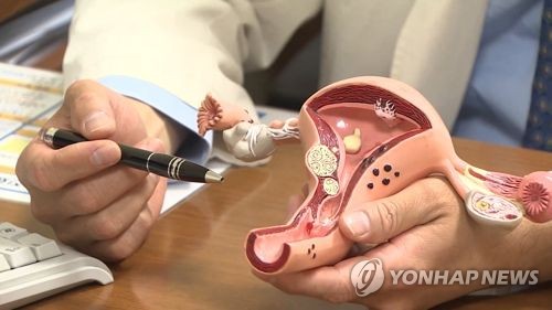 '연간 8회 이하'…월경 불규칙하면 다낭성난소증후군 검사해야