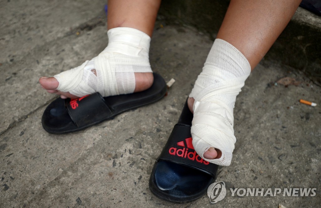 물집 잡힌 캐러밴 이민자의 발